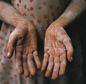 Personal Health Care photo showing the hands and arms of a leper woman wearing a polka-dot dress