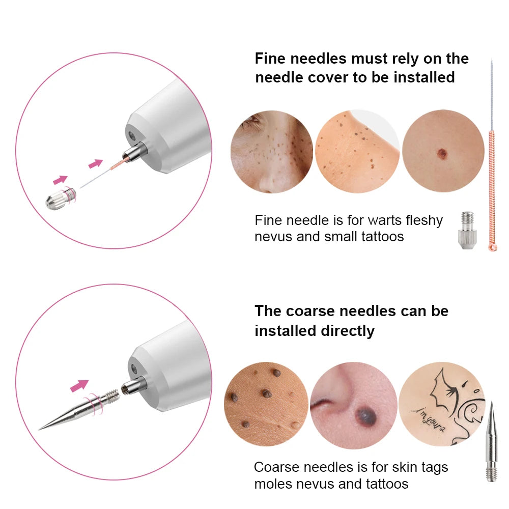 Laser Plasma Pen Skin Tag Remover
