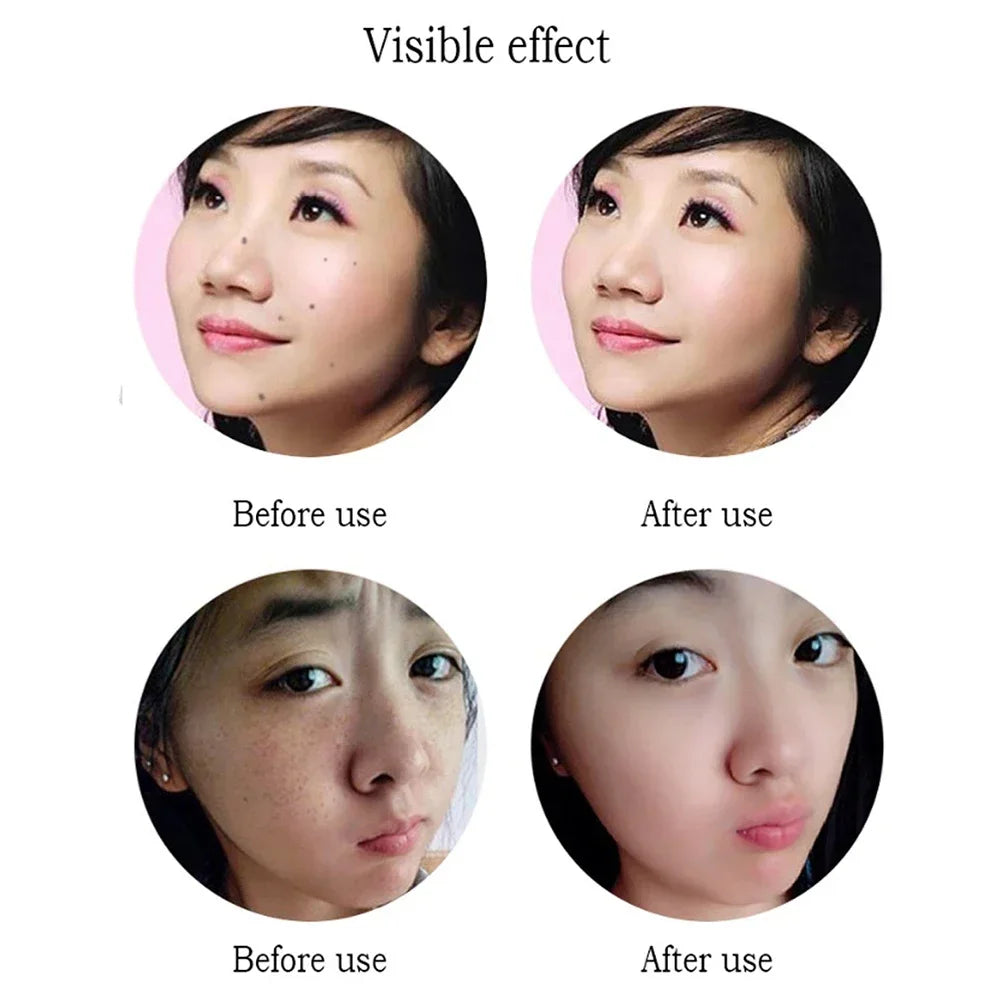Medical Professional Fibroblast Plasma Pen USB