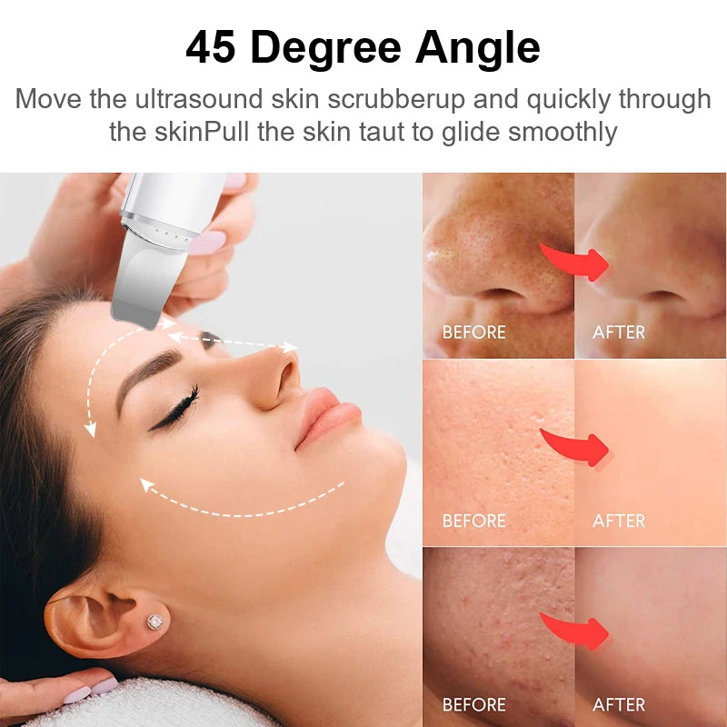 Health care products Ultrasonic Skin Vibration Blackhead Remover 45-Degree Angle quickly and glide smoothy