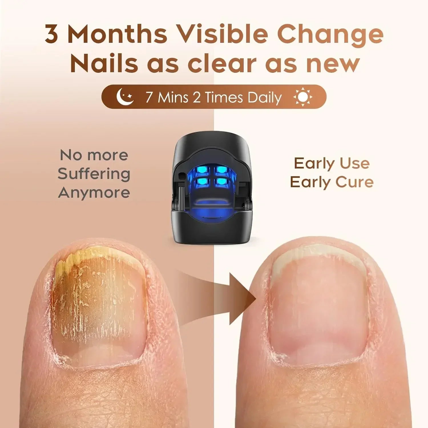 personal-health-care-nail-fungus-device-3-months-visble-change-before-therapy-and-after-nail-as-clear-as-new-picture