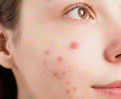 Acne: Causes, Fee Picture of a young girl face with acne. Blog: How to Prevent It, and Easy Skin Care Tips