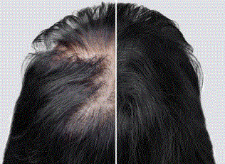 Free Picture of a scalp before and after treatment - Blog: t Is treating baldness realistic?
