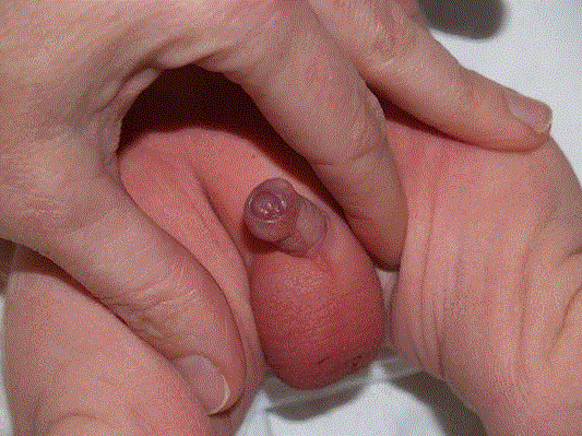 Free Picture of a baby foreskin - Blog: Proper Care for Baby Boy’s Foreskin: Do’s and Don’ts.