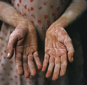 Best methods to prevent leprosy