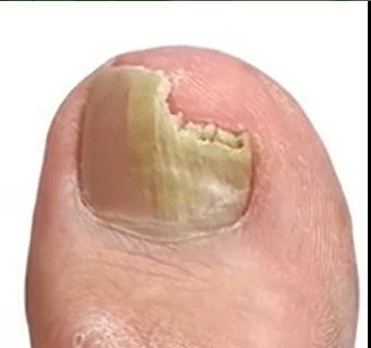 Personal Health Care Photograph of a Fungus on the Big Toe