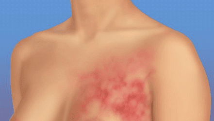 Using probiotics as an agent to combat the risk of cancer.
