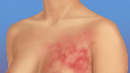 Using probiotics as an agent to combat the risk of cancer. The picture shows a woman with breast cancer