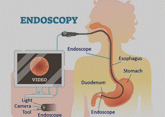 Free Illustration of an endoscopy of the stomac - Blog: Stomach or duodenal ulcer: what to do?