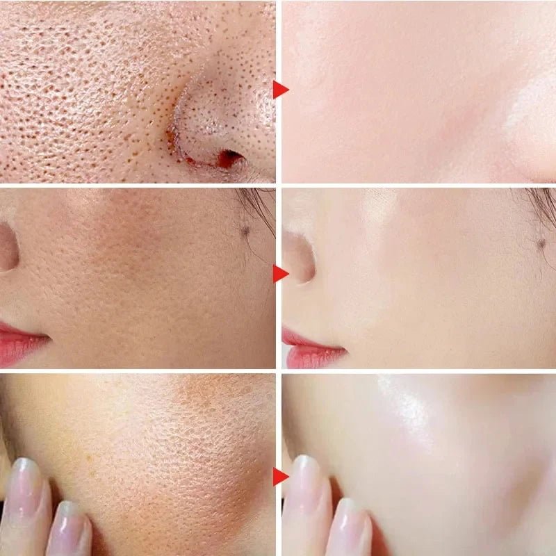 Personal Health Care Salicylic Acid Shrink Pore Cream