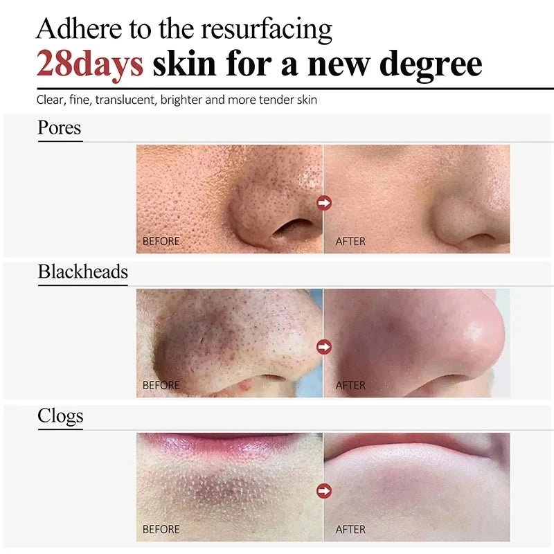 Personal Health Care Salicylic Acid Shrink Pore Cream