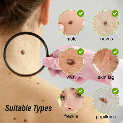 Laser Plasma Pen Skin Tag Remover