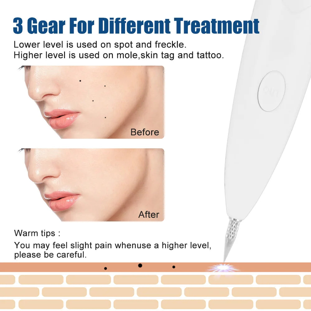 Plasma laser Jet Pen Tattoo + Freckles Removal