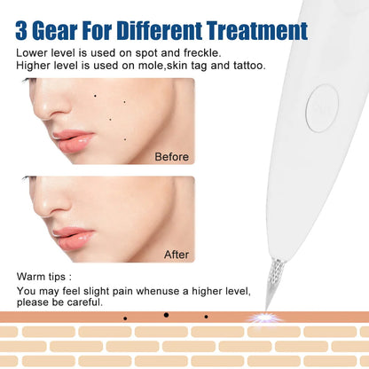 Plasma laser Jet Pen Tattoo + Freckles Removal