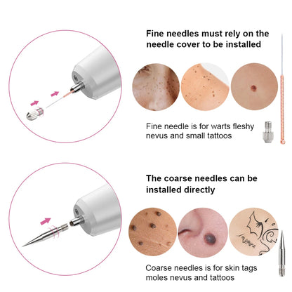 Laser Plasma Pen Skin Tag Remover