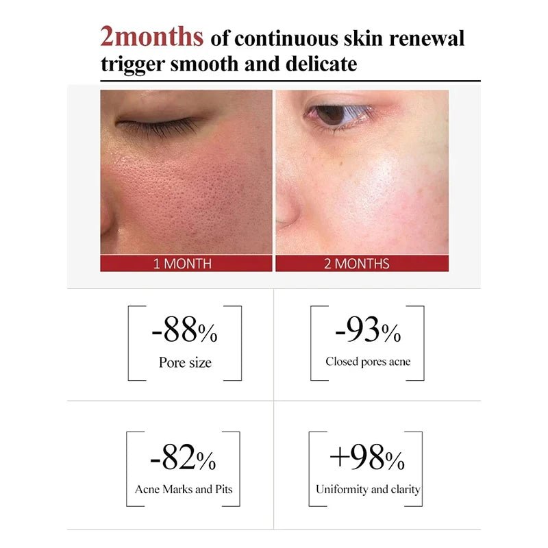 Personal Health Care Salicylic Acid Shrink Pore Cream