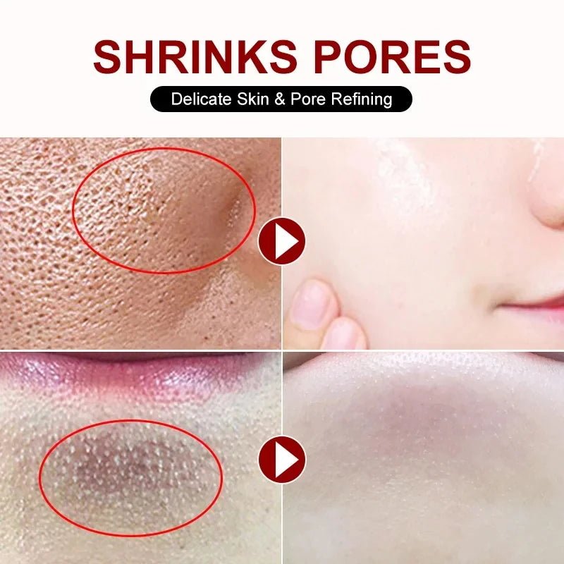 Personal Health Care Salicylic Acid Shrink Pore Cream