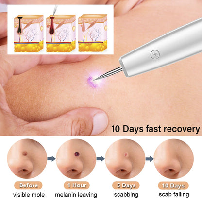 Laser Plasma Pen Skin Tag Remover