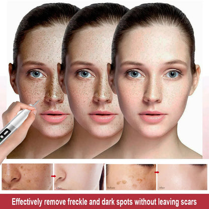 Laser Plasma Pen Skin Tag Remover