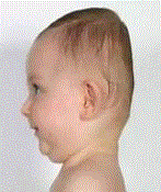 Baby health Care, Picture of a flat head baby syndrome, Blog: What causes flat head syndromes?