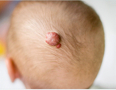 Baby Health Care, Picture of a strawberry birthmark on a baby, Blog: Birthmarks