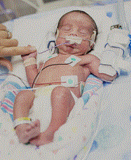 Baby Health Care, Picture of a premature baby, Blog: How to take care of a premature baby?