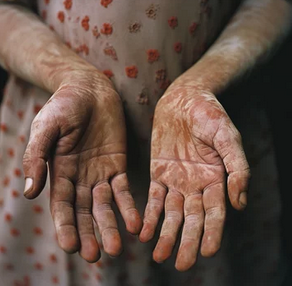 Personal Health Care, Picture of a young girl wearing a peacock dress showing her two open hands in front of her, affected by leprosy, Blog: Best method to prevent leprosy
