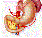 Personal Health Care, drawings of a stomach to show how heartburn forms, Blog: Heartburns six (6) natural and effective ways for lasting relief.