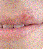 Personal Health Care, Picture of herpes on a woman mouth lip, Blog: Herpes: What treatments are available to cure it permanently?