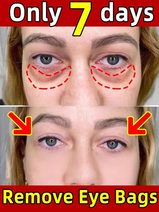 personal-health-care-remove-eye-bags-only-7-days-woman-face-picture-before-after-treatment