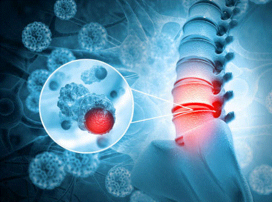 Personal Health Care, Diagram of syringomyelia between the vertebrae of a human spine, Blog: Understand Syringomyelia
