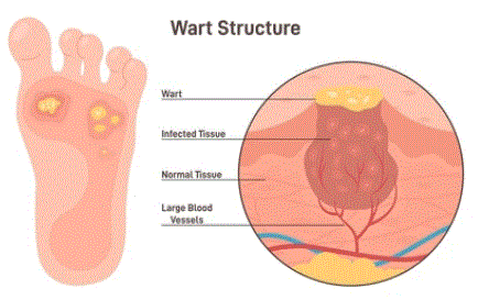 Personal Health Care, Drawing of a wart, Blog: How to get rid of a wart