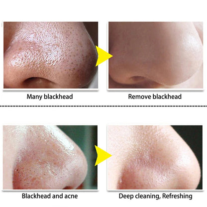 Personal Health Care Acne Treatment Face Mask