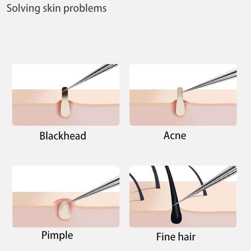 Acne Blackhead Remover Tools
